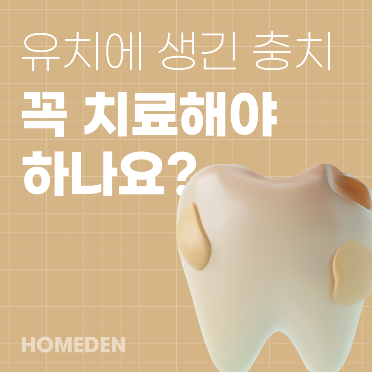  유치에 생긴 충치 꼭 치료해야 하나요?