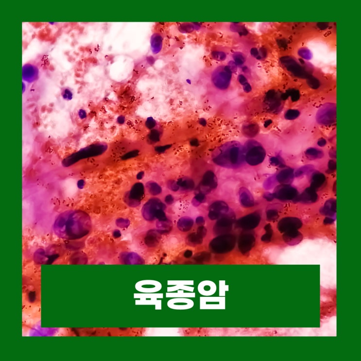  육종암 종류 지방 골 자궁 혈관 육종 증상