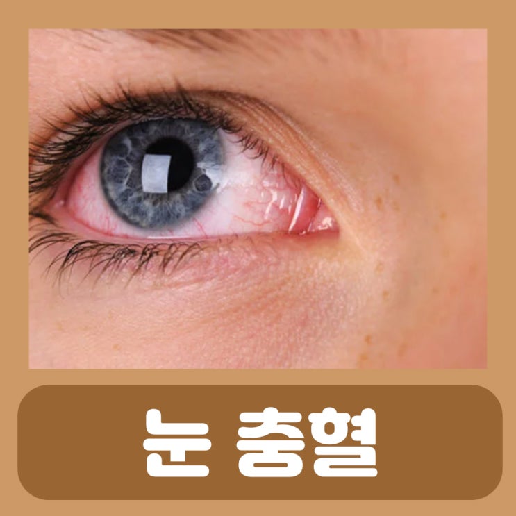 눈 실핏줄 터짐 원인 결막하 출혈 원인 한쪽 눈 충혈 원인 눈핏줄 터짐 눈에 실 핏줄