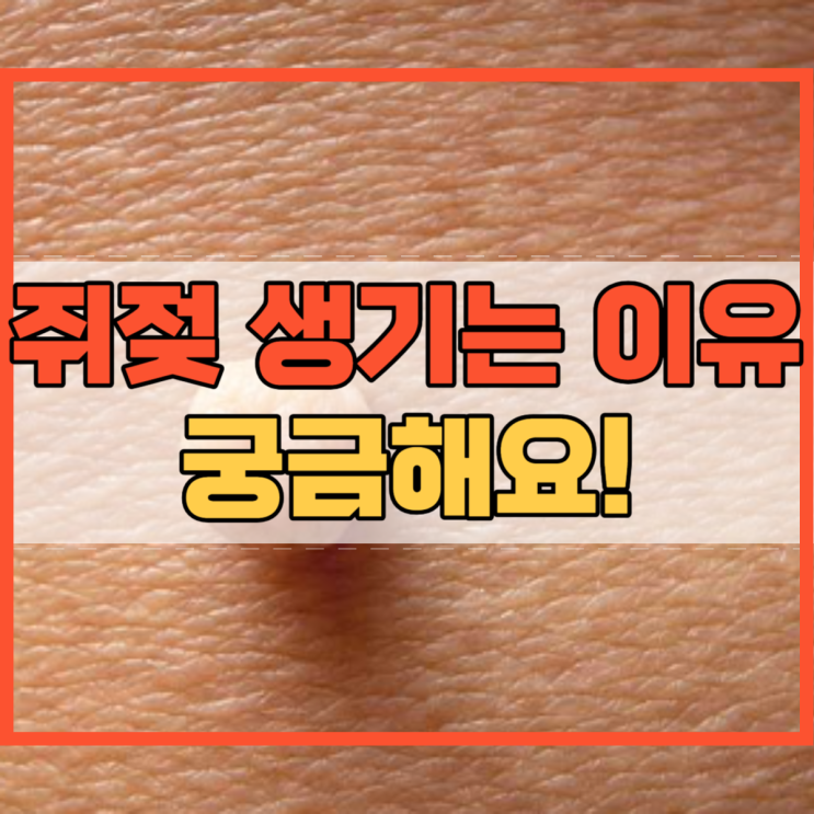  쥐젖 생기는 이유 발생률과 증상 및 제거 방법!