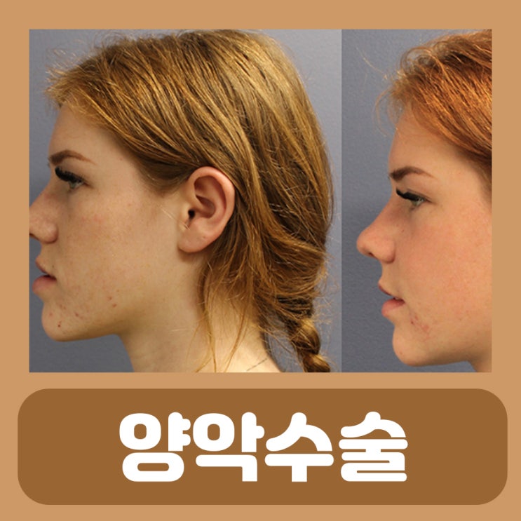  양악수술 입원 붓기 기간 비용 부작용