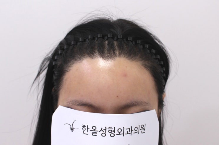  20대 여자 헤어라인 재수술 2주 경과