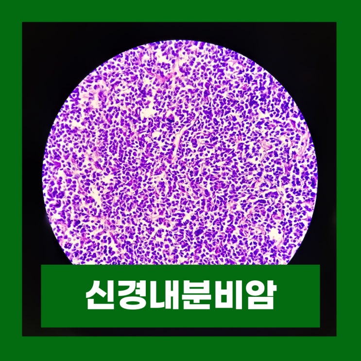  신경내분비암 증상 신경내분비 세포 종양