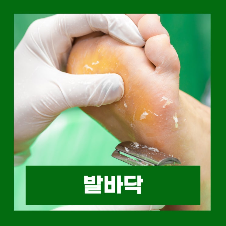  발바닥 껍질 벗겨짐 원인별 치료법