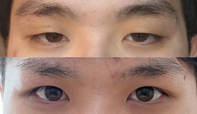 남자안검하수수술로 남자눈매교정 개선된 후기