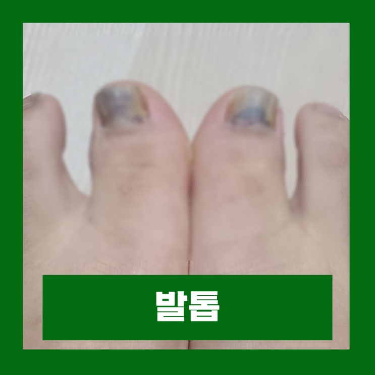  발톱 들렸을때 발톱피멍 응급처치 빠졌을때 병원