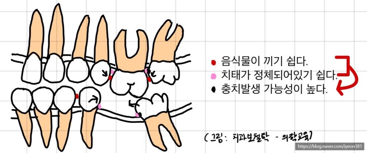 치아가 빠졌을 때 생기는 문제점, 치아가 쓰러지는 이유, 치아가 움직이는 이유 치아가 빠졌을 때 생기는 문제점, 치아가 쓰러지는 이유, 치아가 움직이는 이유