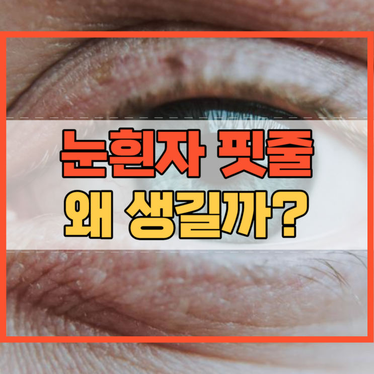  눈흰자 핏줄 눈 흰자 핏줄이 생기는 이유?