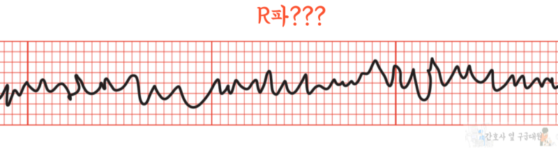 제세동 관련 용어 정의 : Cardioversion vs Defibrillation : 네이버 블로그