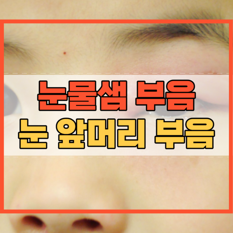  눈물샘 부음 눈 앞머리 부음의 원인 및 증상!