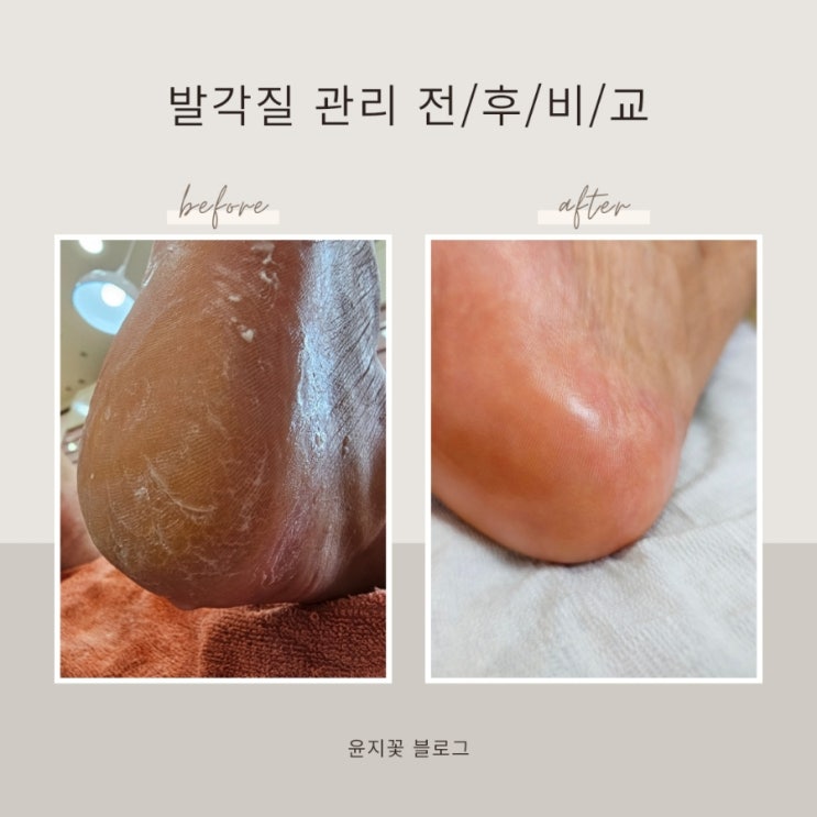  대구 발관리 각질 추천 해롯네일 내성발톱교정 무좀 전문