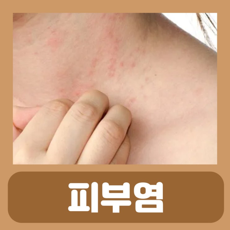 접촉성 피부염 수포 증상 목 얼굴 다리 손등 손가락 손바닥 몸에 피부 수포 알레르기 피부염 연고