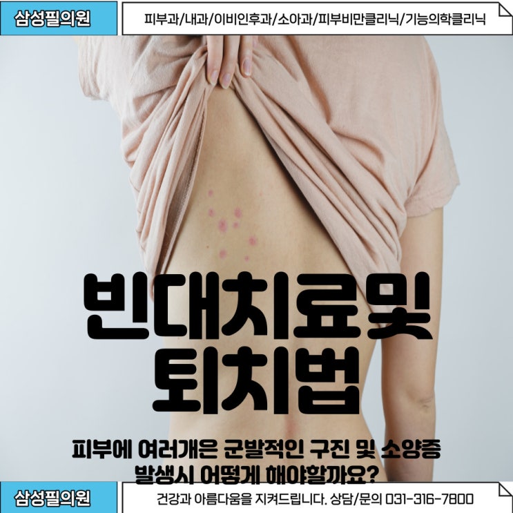  빈대 물렸을때 대처방법, 퇴치방법을 알아볼까요?