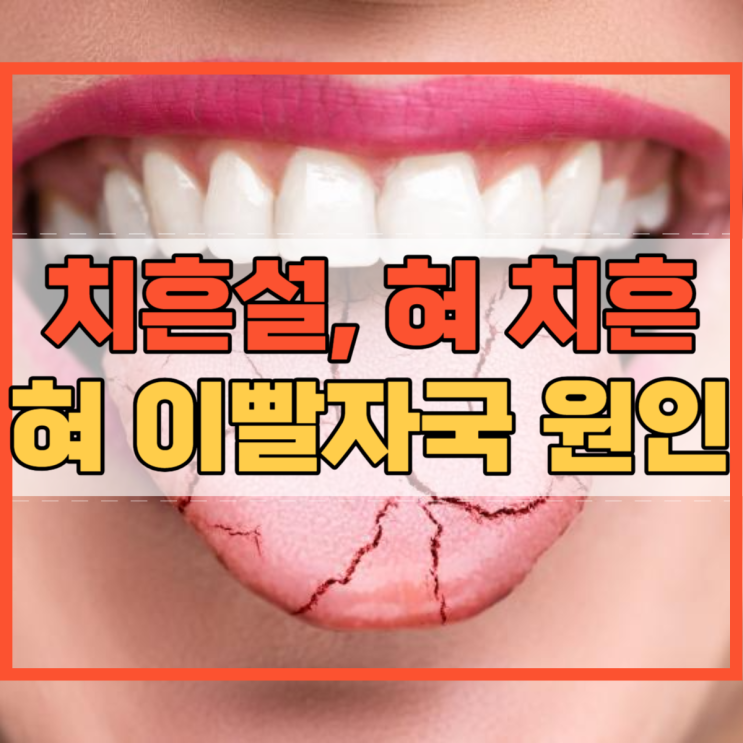  치흔설 혀 치흔 이빨자국 원인과 예방 방법!