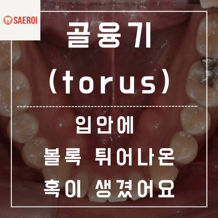  이거 입안에 종양인가요? 혹 같은데요...(feat.골융기)