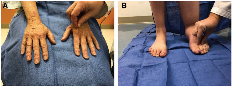[림프부종의 증상] 림프부종의 증상은 어떤가요? (feat. 함요부종, 봉와직염, 성형외과 전문의) : 네이버 블로그