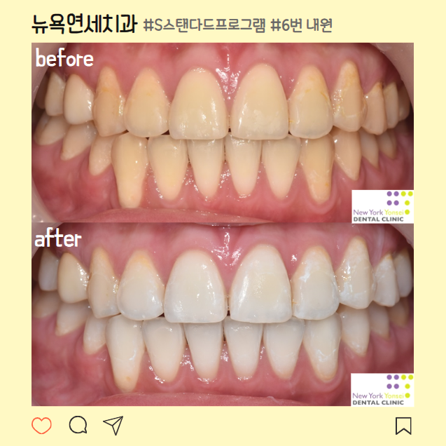 강남역 치아미백 부작용 없고 효과 좋은 곳 Ι 뉴욕연세치과
