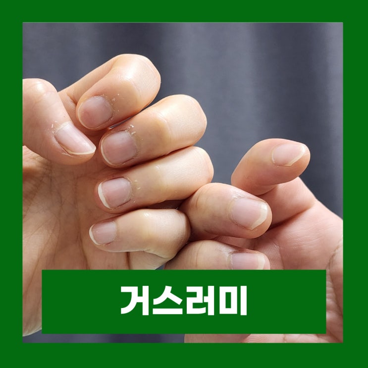  손톱 거스러미 염증 원인 조갑주위염 생인손 증상 치료