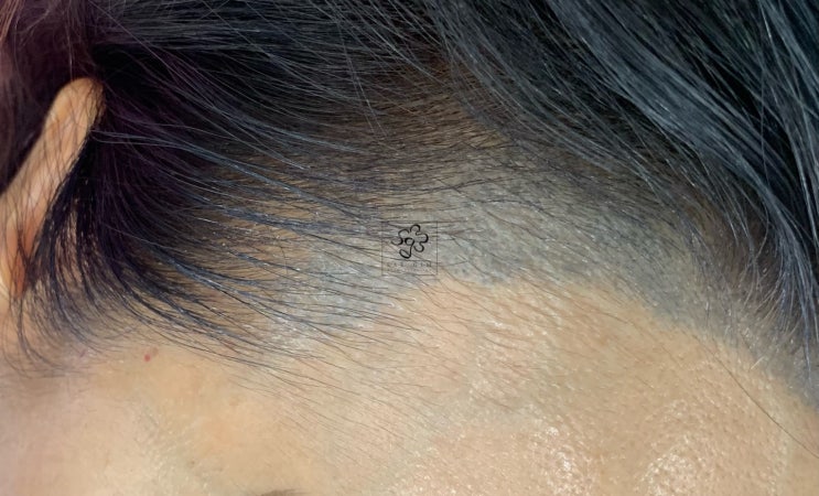  두피 문신 헤어라인 부작용, 망한 SMP