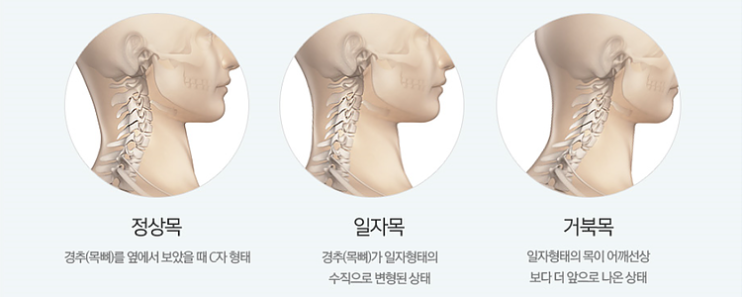  [개봉동 필라테스] 일자목 그냥 놔두면 큰일나요 !! 일자목 교정 스트레칭 알려드릴게요 