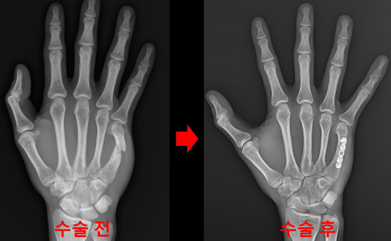 5번째 중수골 골절의 재골절 (5th Metacarpal shaft refracture), 손등 재골절에서의 올바른 치료 방법 ...