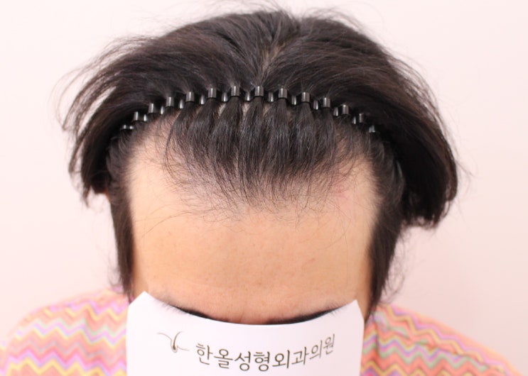  40대 남자 비절개 마이크로컷 헤어라인 3000모