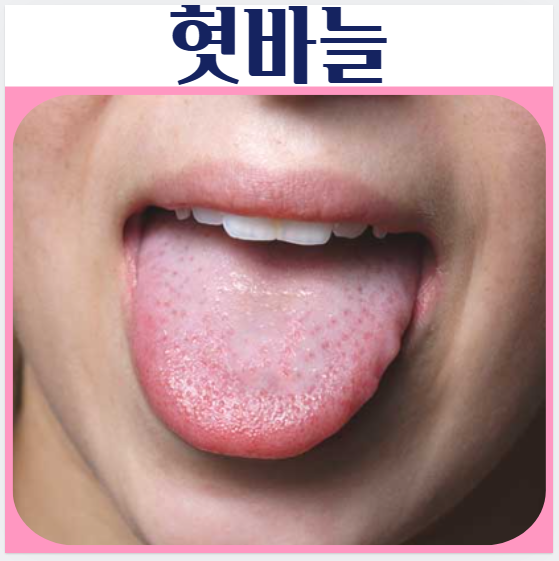 혀바늘 원인 혓바늘 관리 혀통증