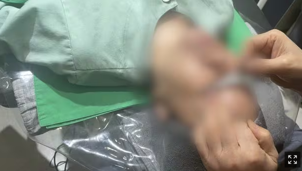 법원은 티눈 냉동응고술이 ‘수술’이라는데… 보험약관은 정반대 법원은 티눈 냉동응고술이 ‘수술’이라는데… 보험약관은 정반대
