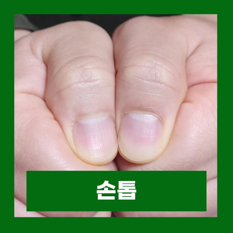  엄지손톱 세로줄 흑색종 원인 손톱 관리방법