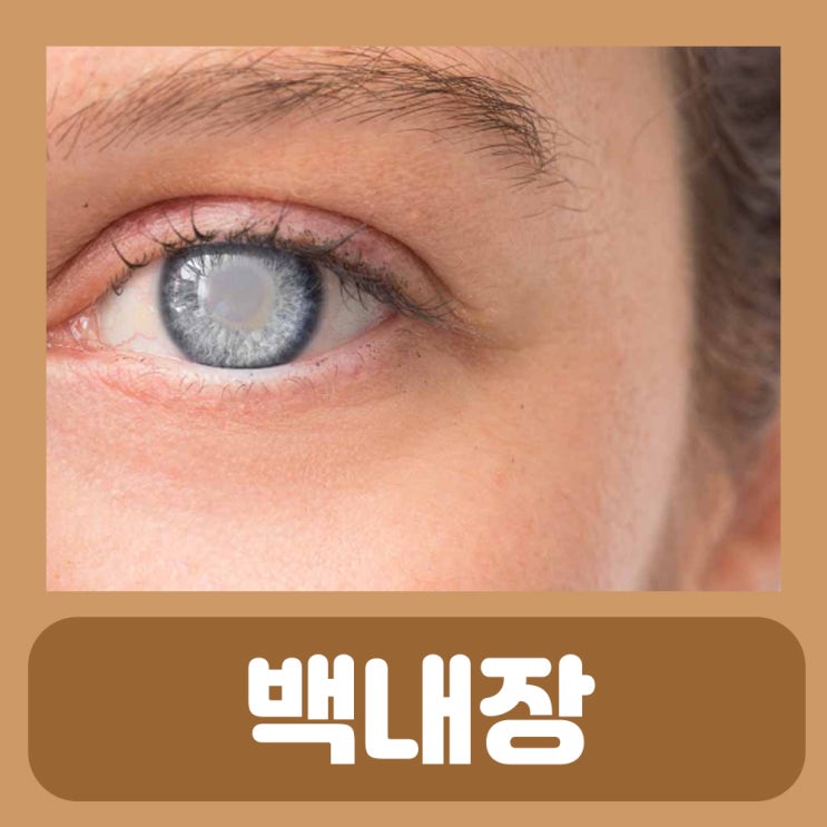 노인 백내장수술비용 20대 백내장 원인 수술 가격