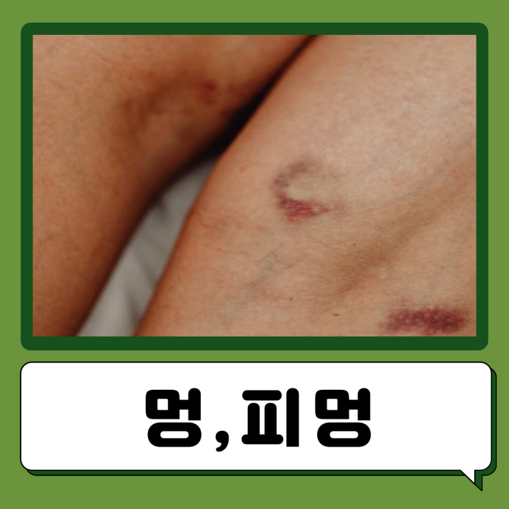  멍 빨리 빼는법 피멍 빠지는 시간