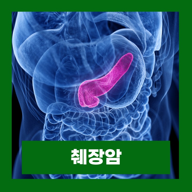  췌장암 초기증상 왼쪽 오른쪽 등통증 완치율