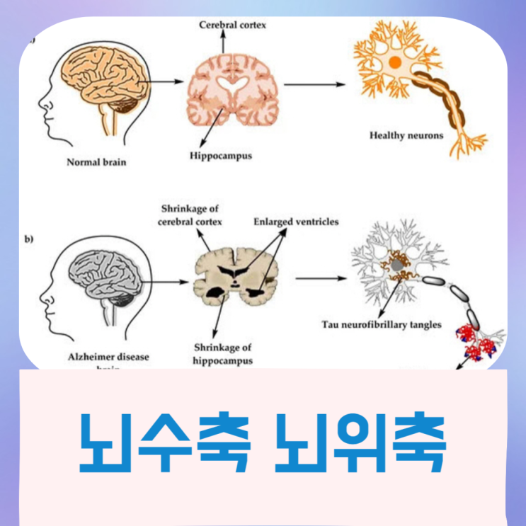  뇌수축 뇌위축 이유 예방법 : 아밀로이드 베타