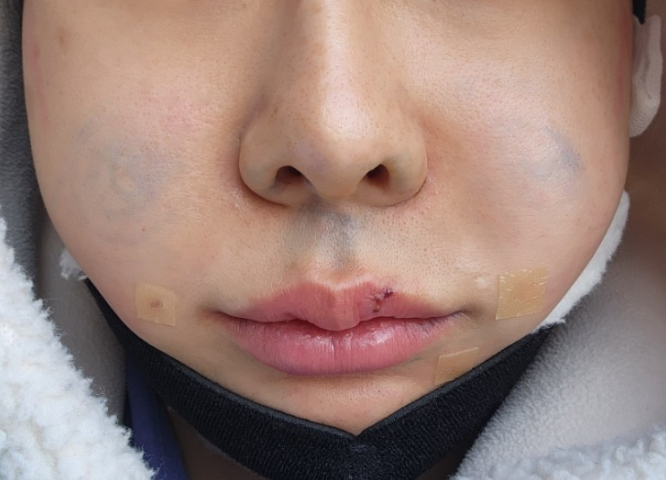  리아이성형외과 이중턱지방흡입 팔자주름지방이식 미니리프팅 (얼굴, 턱선 리프팅) 상담받고 수술 받은 후기