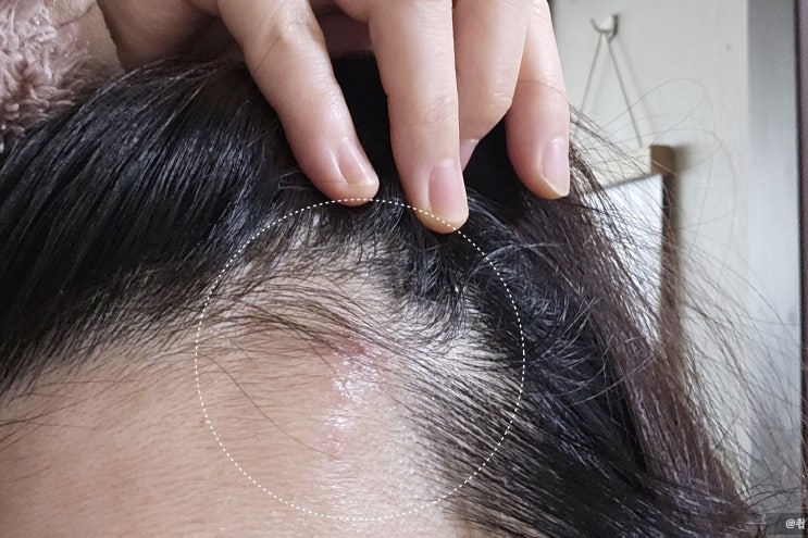  대상포진 초기 증상(눈, 얼굴) 및 치료 후기
