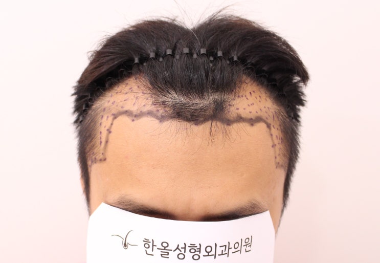  30대 남성 헤어라인 비절개 마이크로컷 3000모