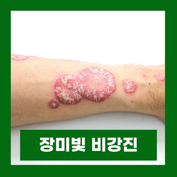  장미빛 비강진 원인 증상 장미색 피부 반점 전염 치료