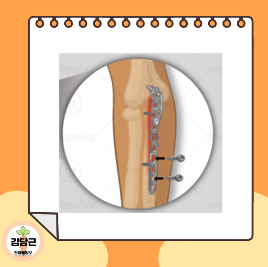 의학용어 ORIF CRIF 뜻과 치료방법의 차이점 알아보기 : 네이버 블로그