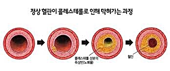  혈청 지질 죽상동맥경화증 발달