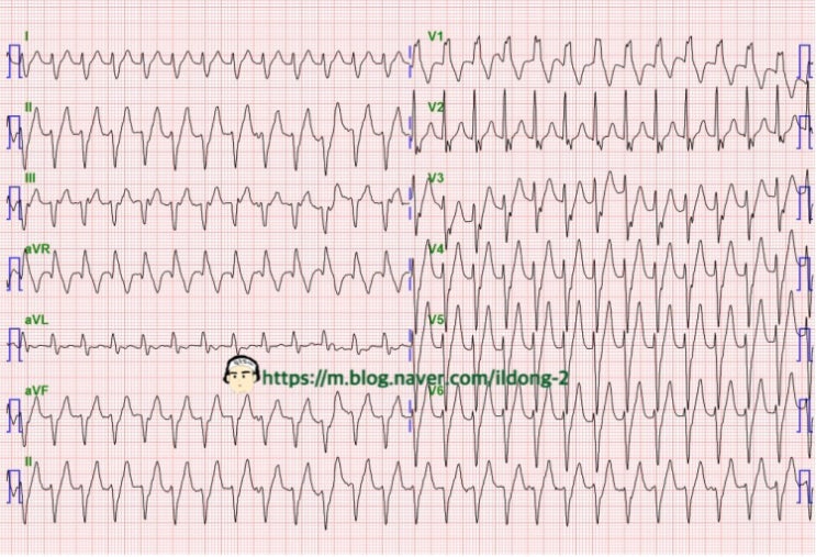  베라파밀에 반응하는 부정맥 fascicular VT (섬유속 심실빈맥)