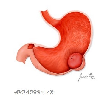 기스트암 증상/위장관기질종양/인피니트 남우현/프로필