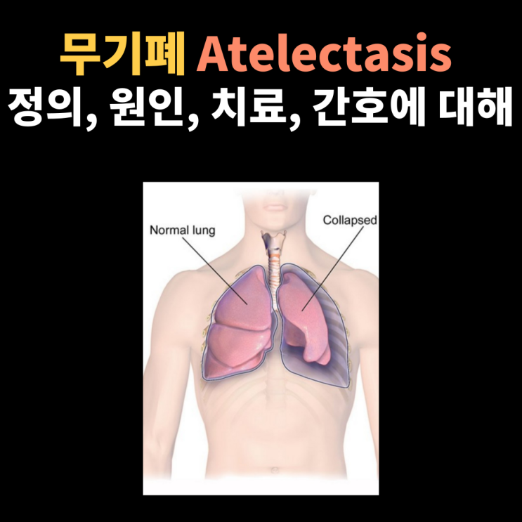  Atelectasis 무기폐의 정의, 원인, 기흉과의 차이점, 치료 및 간호에 대해서 알아봐요~