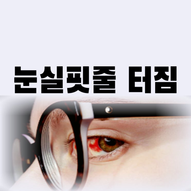 눈 실핏줄 터짐 충혈 결막하 출혈 원인 냉찜질 안약까지