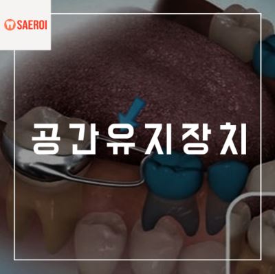 유치가 일찍 빠졌을 때는 공간유지장치를 꼭 하세요