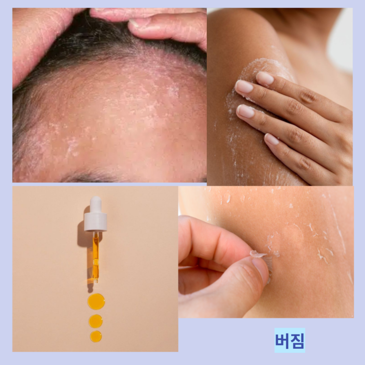 얼굴 버짐 마른버짐 입가버짐 원인 및 케어법 얼굴 버짐 마른버짐 입가버짐 원인 및 케어법