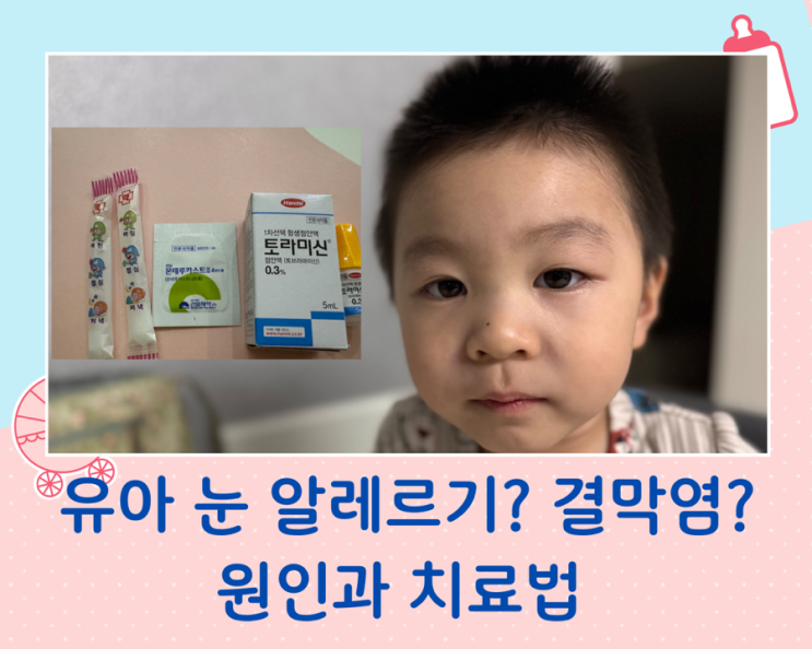 유아 눈 알레르기, 결막염 원인과 치료법