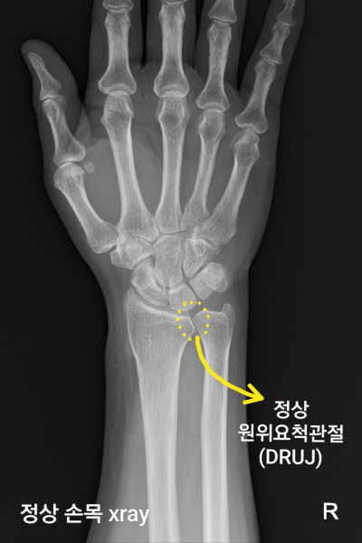 원위요골골절 (Distal radius Fracture)과 동반된 개방성 원위요척관절 손상 (DRUJ instability ...