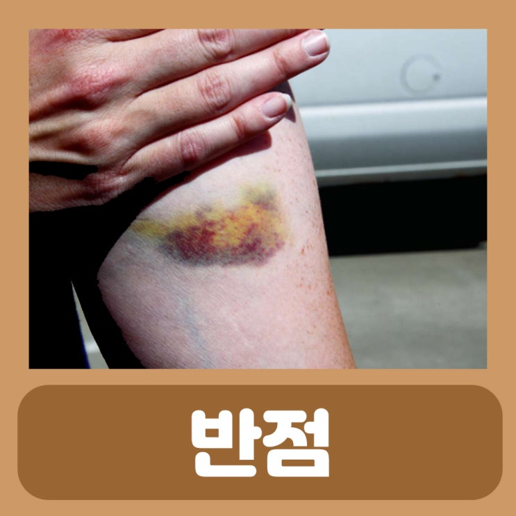  점상 출혈 반상 출혈 차이 원인