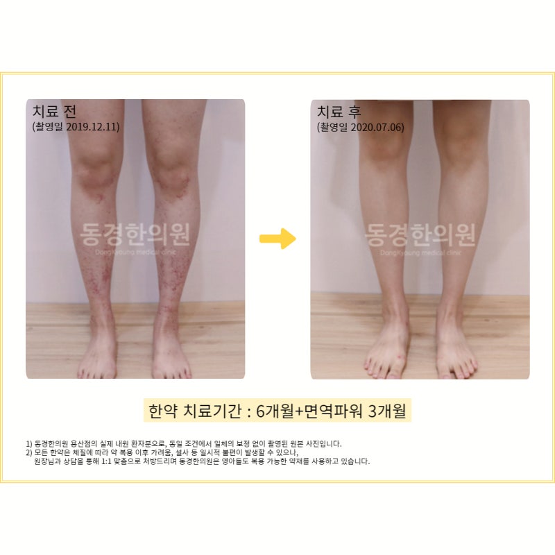 hs자반증, 정확한 진단이 중요합니다.
