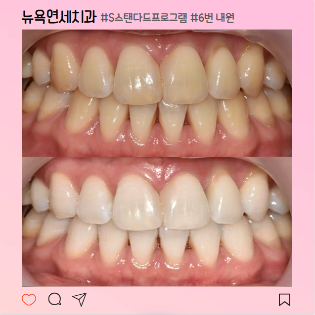 [강남역 치과] 안전하고 효과 좋은 치아미백 솔직 후기